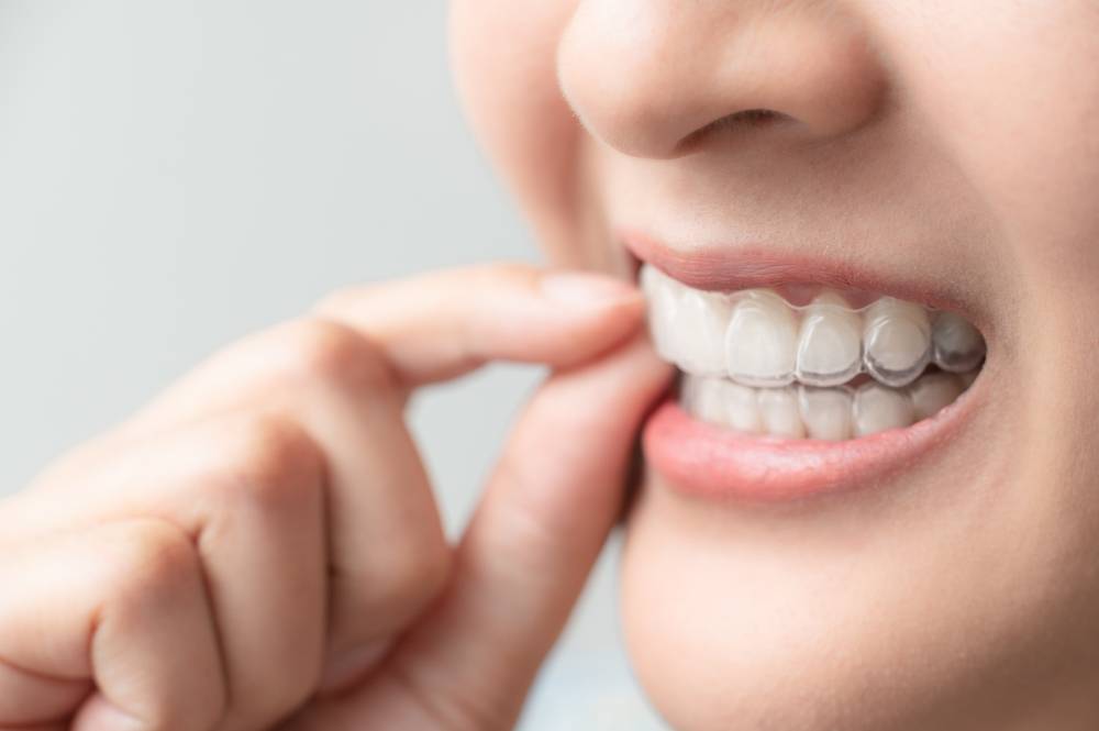 Woman,Wearing,Orthodontic,Silicone,Trainer.,Mobile,Orthodontic,Appliance,For,Dental