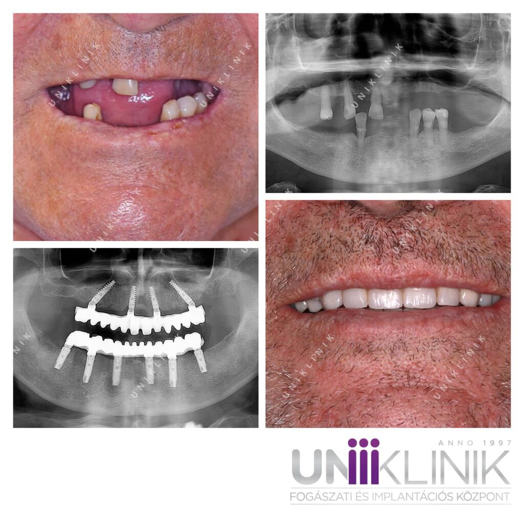All on 4 és all on 6 implantátumos fix fogsor