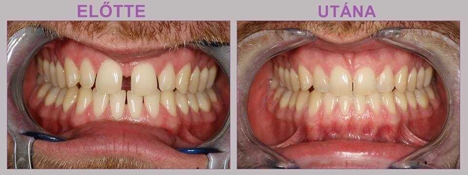 Clear aligner láthatatlan fogszabályozás esettanulmány