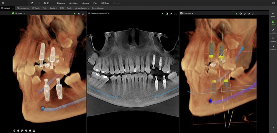 DEXIS Implantálás