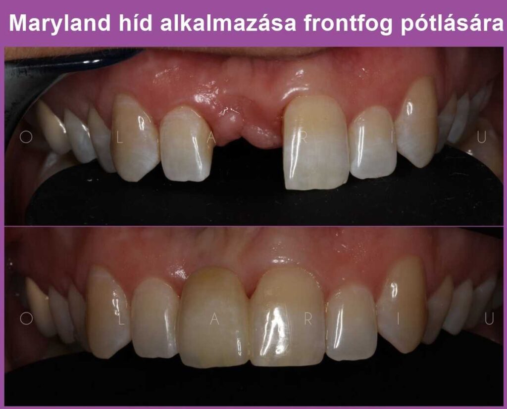  préskerámia konzolhíd (maryland híd) alkalmazása frontfog pótlására