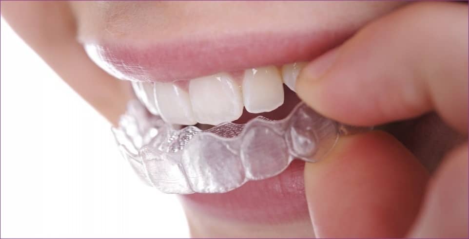 clear-aligner.jpg#asset:54678
