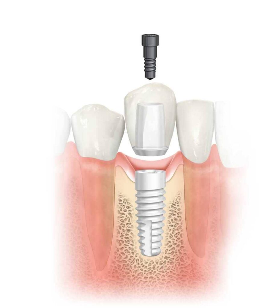 Fog implantacio