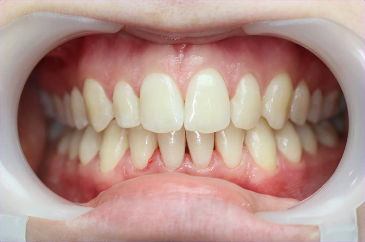 fogkő3-utána.JPG#asset:57404