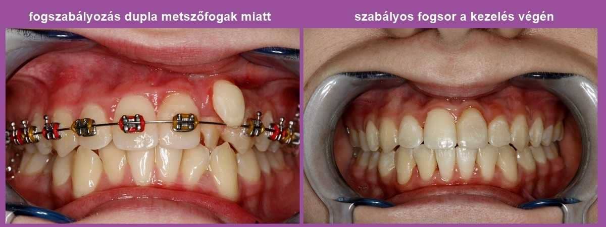 fogszabalyozas-szamfeletti-kismetszok-miatt.jpg#asset:32103