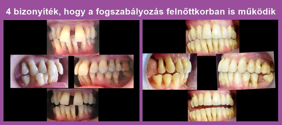 fogszabalyozas_felnottkorban.jpg#asset:33791