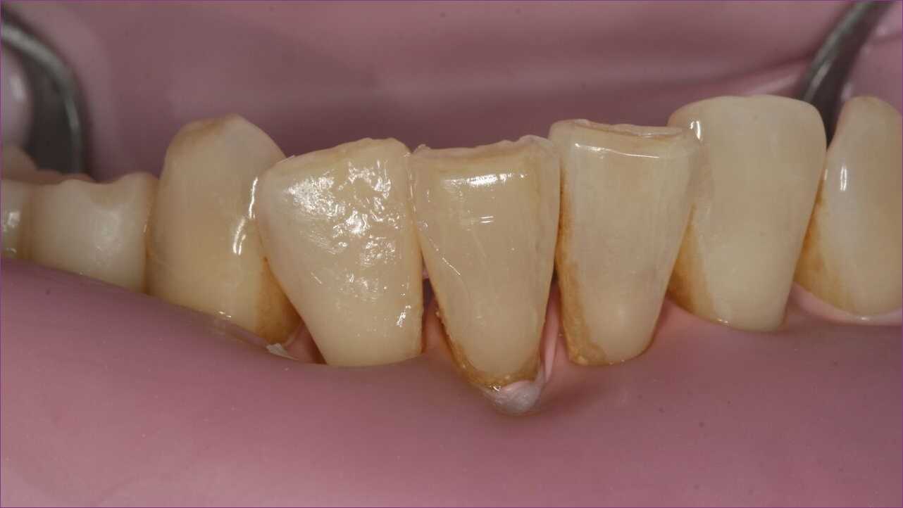 fogszuvasodas-utana.jpg#asset:34090