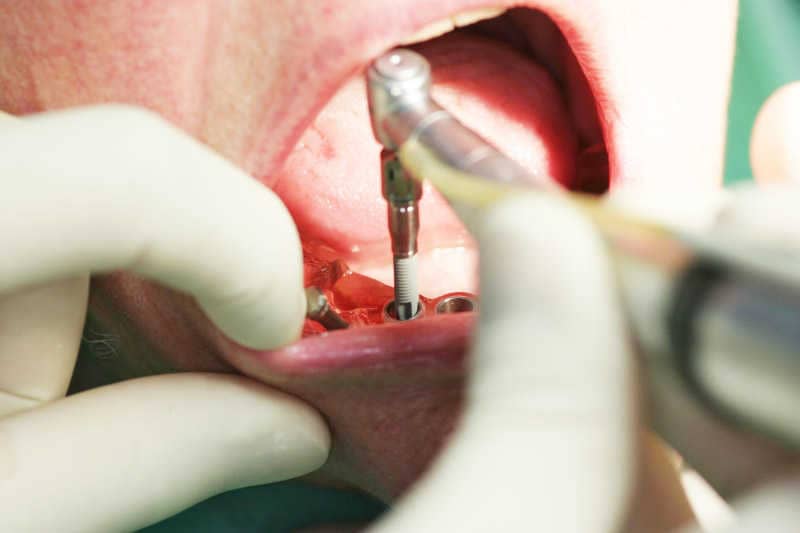 implant-01.jpg#asset:58193