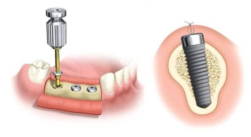 implant-03.jpg#asset:57765