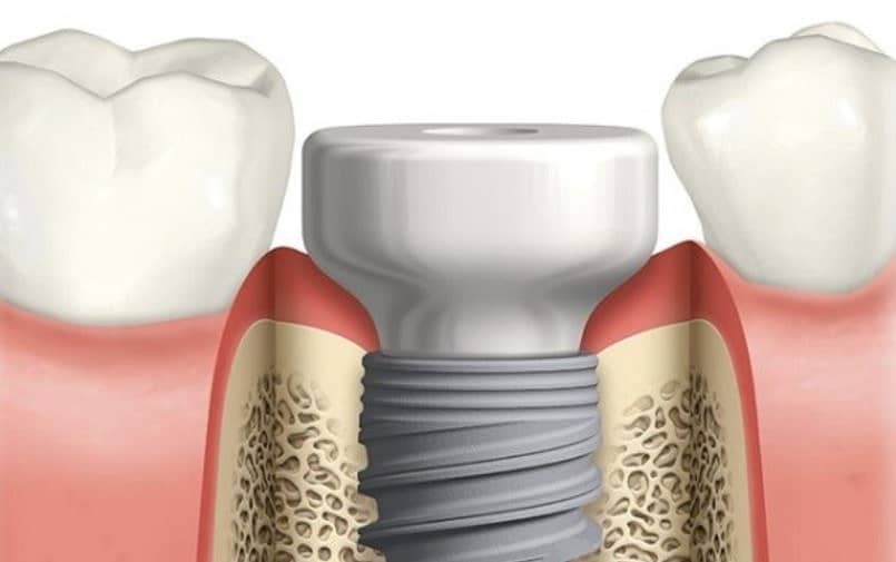  implantatum beultetes gyogyulasi csavar