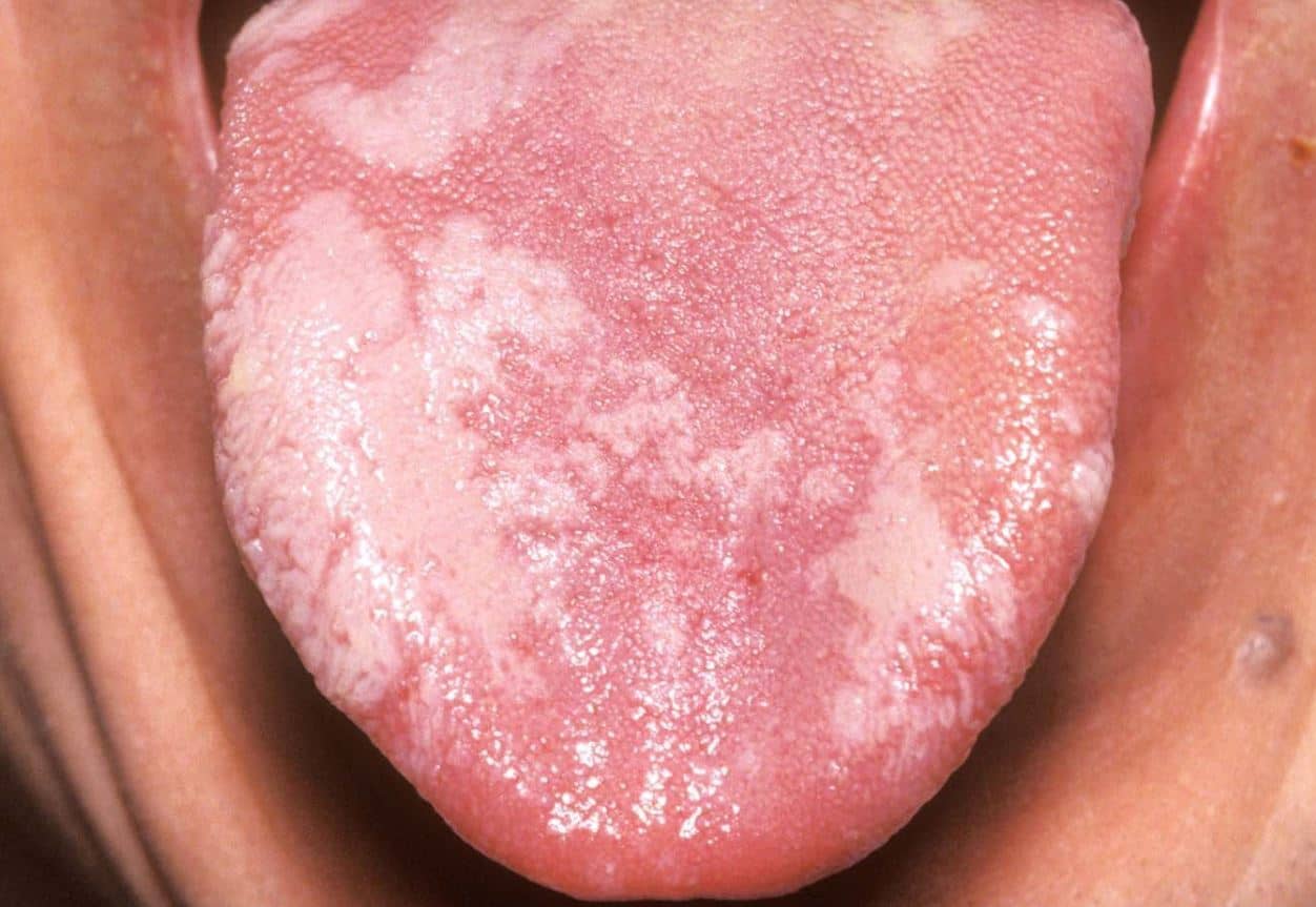 leukoplakia