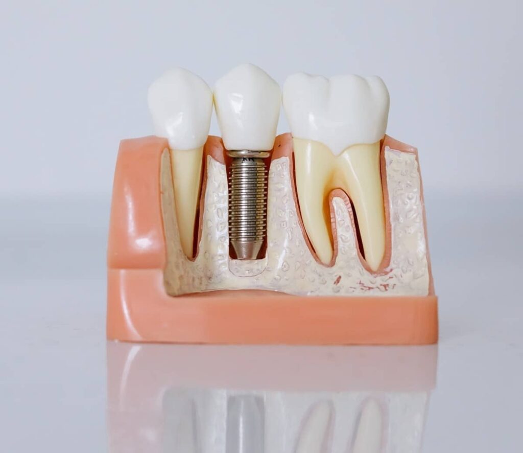  mi az implantatum