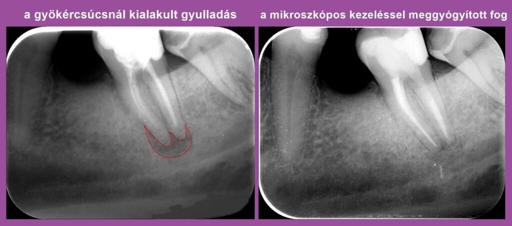 A mikroszkópos gyökérkezelés újra fogat mentett