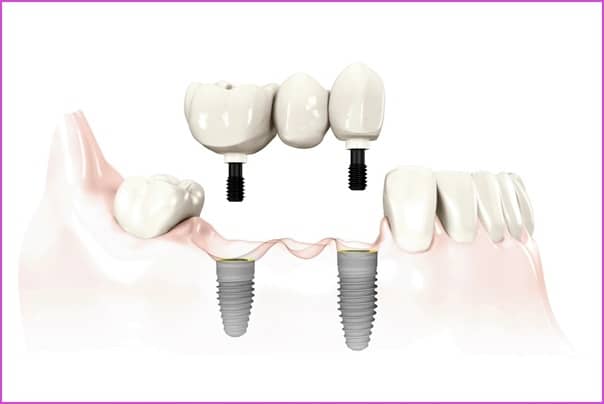nobel_implant_hid.jpg#asset:35334