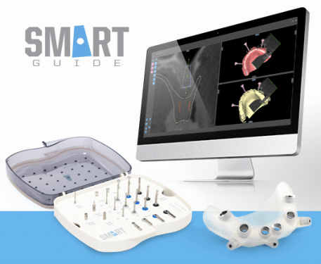 Img smart guide implantáció tervezés