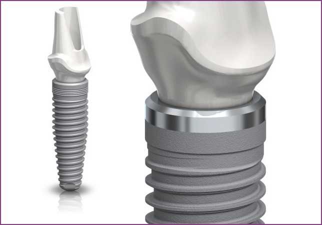 titan-implantatum.jpg#asset:31370