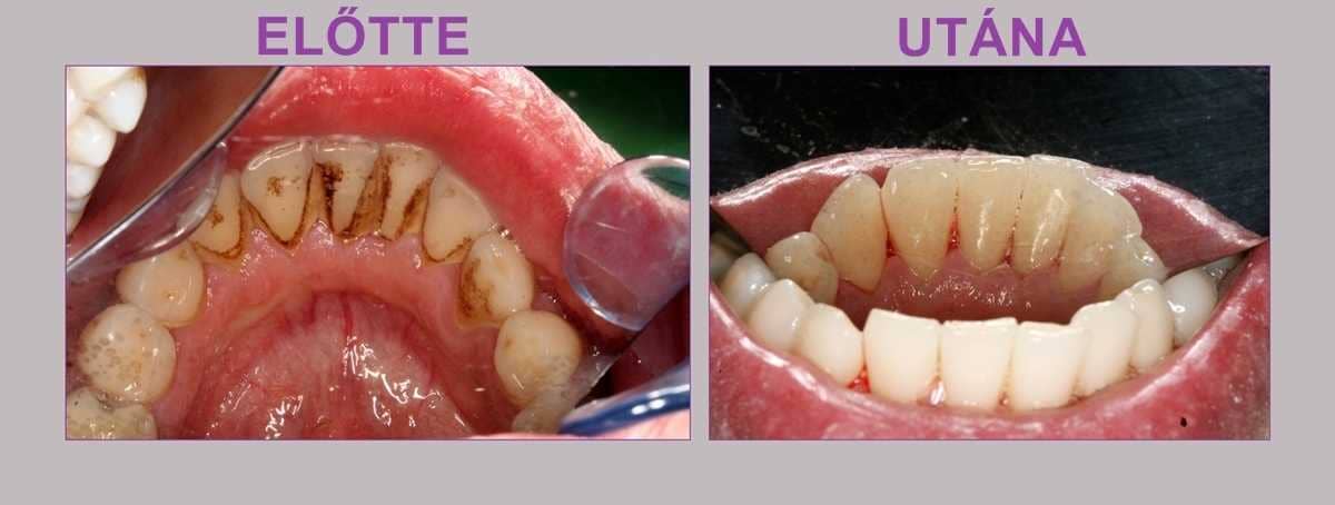dentálhigiénia szolgáltatás Budapesten: fogkő-eltávolítás előtt és után